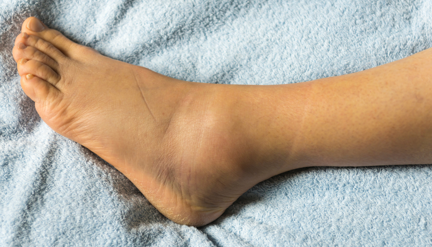 Podvrtnuty_kotnik_Priznaky_lecba_a_prevence