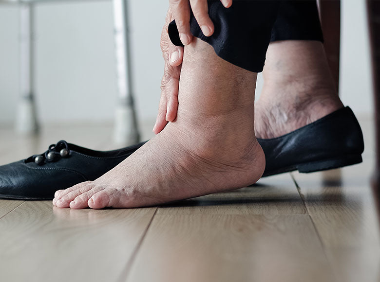 Chodidlo s křečovými žilami