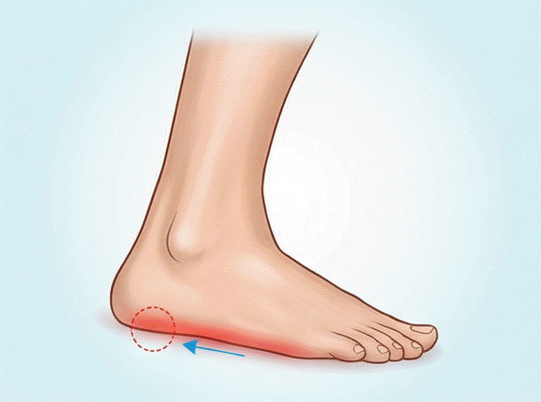 Bolest chodidla při zánětu plantární fascie nazývaném plantární fasciitida