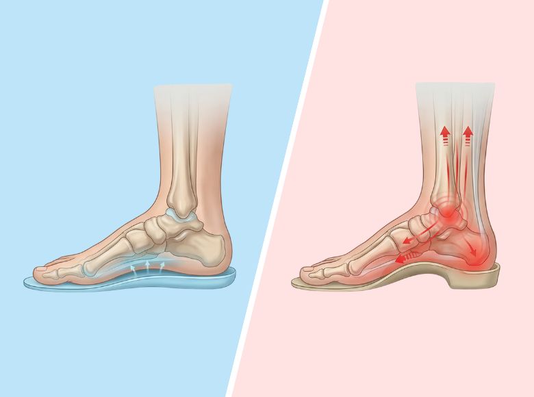 Porovnání stélek s tvarovanou klenbovou částí a vložek Medicovi
